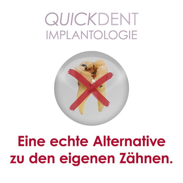 Quickdent Implantologe - Eine echte Alternative zu den eigenen Zähnen